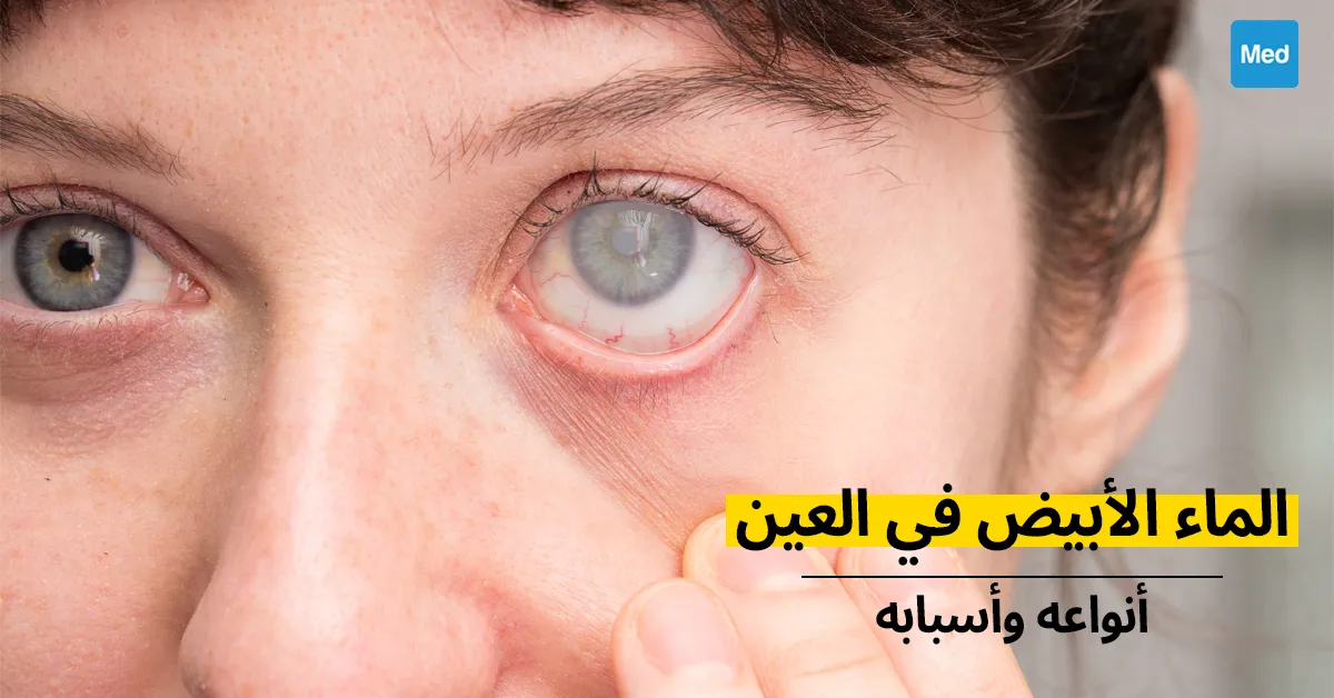 الماء الأبيض في العين : أنواعه وأسبابه